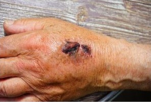 hand with a burn scar